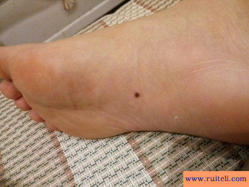 女人脚底有痣